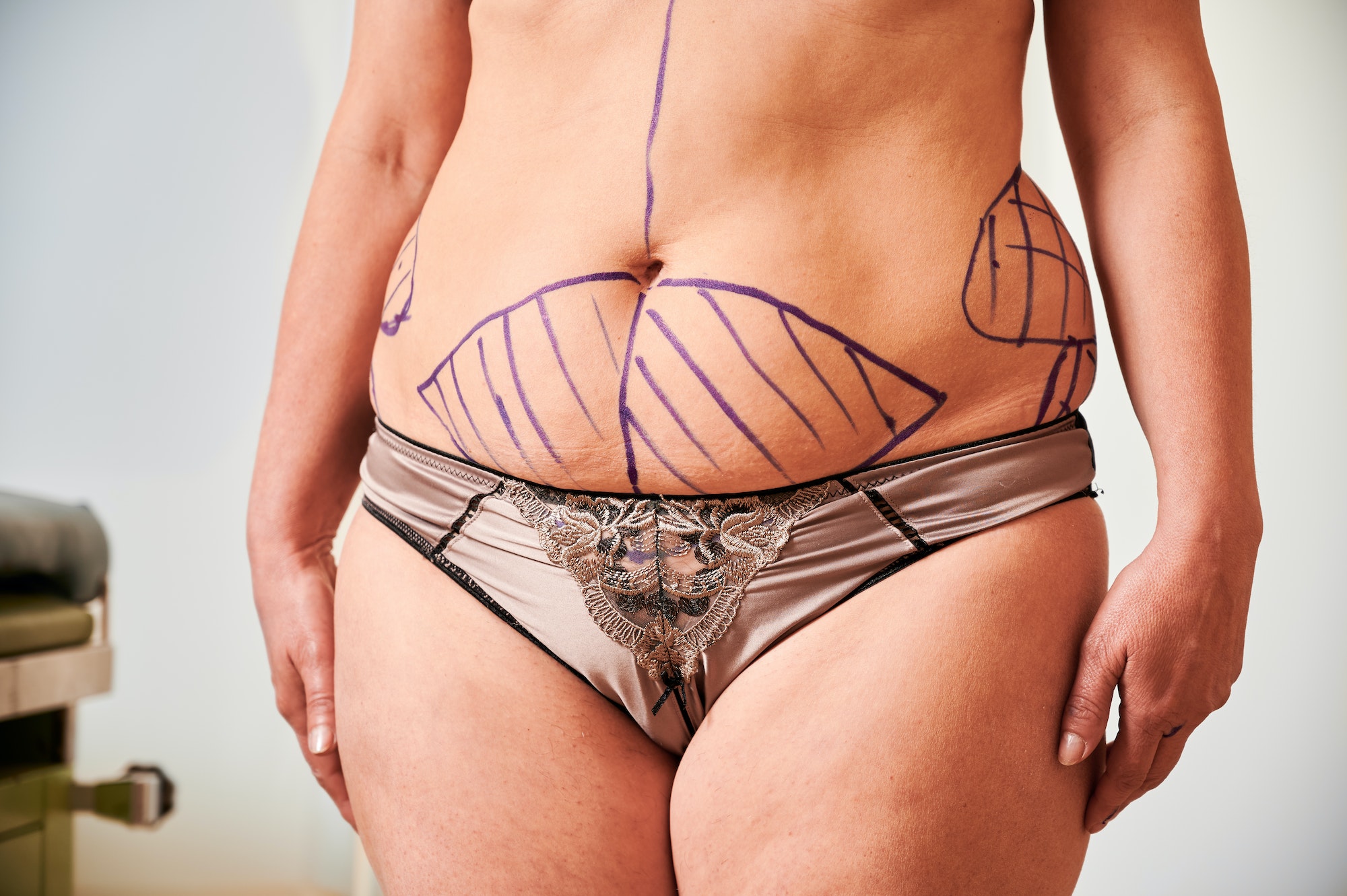 Woman body with marks for plastic surgery.